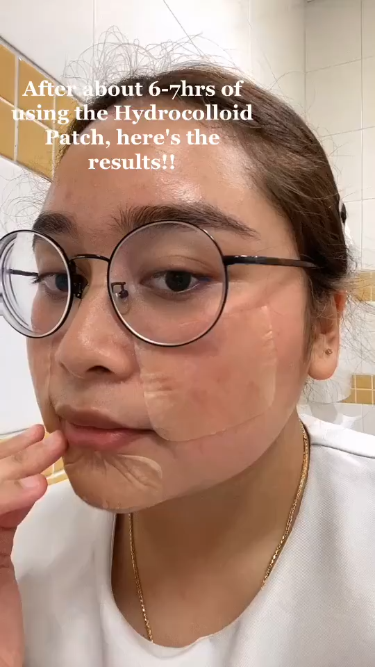 Tt Grade Hydrocolloid Sheet Roll – Cut-to-Fit Dressing for Wound Care & Acne/Pimple Treatment