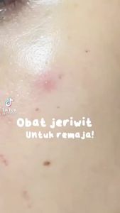 ADARA Acne Gel Bee Clear Extra Formula