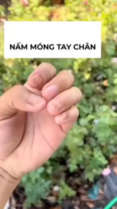 [ SET 3 CHAI ] Nấm Móng Tay Móng Chân Dạng Xịt Giúp Giảm Nấm Dưỡng Móng Tay Móng Chân Kháng Khuẩn Giảm Đau Nhức