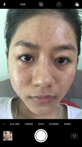 Kem Chấm Mụn Oribe – Giúp Giảm Mụn Mờ Thâm Sẹo Tái Tạo Da Phục Hồi Làn Da Sau Mụn Tuýp 20g