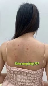 Kem URE Dưỡng Ẩm Ngăn Ngừa Viêm Nang Lông Lỗ Chân Lông To Cấp Ẩm Cho Da