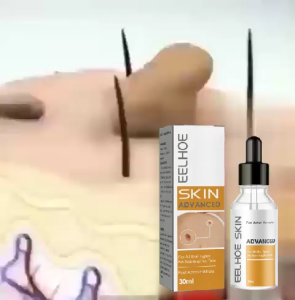 Eelhoe Wart Removal Essence 30ml Cleansing Meat Effective Remover Repair Cleansing Care Liquid