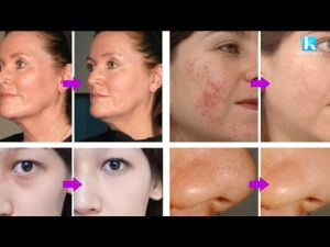 ori hologram derma roller stainless steel skin face penghilang bekas bopeng jerawat