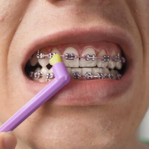Curaprox Single Tuft Toothbrush CS 1006 bristles for braces ortho and gum care
