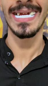 Gigi Palsu 1 Set Atas Bawah Snap On Smile 100% Original Authentic