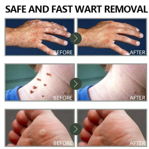 warts remover patch skin tag remover patch moles skin care ketuat tahi lalat 120pcs克疣痣护理贴