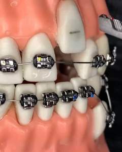 BEHELLDENTAL - PINSET ORTHO BRACKET HOLDER BEHEL - TWEEZER DENTAL PENJEPIT JEPITAN JEPIT SS STAINLESS STEEL - INSTRUMENT INSTRUMEN DOKTER GIGI ANTI KARAT - Alat Pasang Bracket Behel Kawat Gigi Ortho Dental