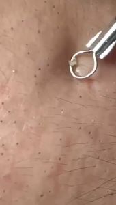 Que Nặn Mụn Trứng Cá Chuyên Nghiệp Cây Lấy Nhân Mụn 2 Đầu A1018