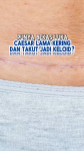 Albuminos - Kapsul Ikan Gabus Kutuk Albumin isi 60 | Obat Pasca Operasi Cesar/Ceasar Halal BPOM