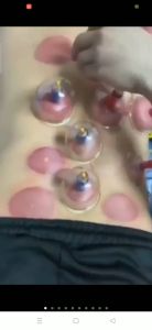 [TẶNG DẦU GIÓ] Bộ giác hơi không lửa 24 ly đủ phụ kiện | Bộ giác hơi 24 cốc loại tốt Hàng chất lượng