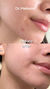 Dr.melaxin TX-Cream 50ml Dark Spot | Skin freckle Cream | Blemishes | Anti-Pigmetation