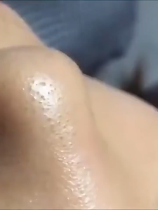 【SG NDD】 Acne Removing Needle Cover BlackheadRemoving Tweezers Clip Blackhead Removal Tool KitPrecisionTweezers and Pimple Needles for AcneIngrown Hairs and Skin Care