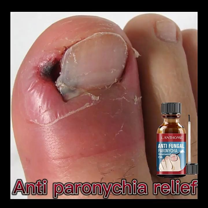 LANTHOME Nail repair Essence Remove Onychomycosis Anti Fungal Dispel