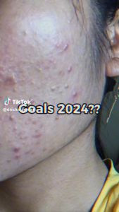 Dricha paket jerawat 1 original bpom