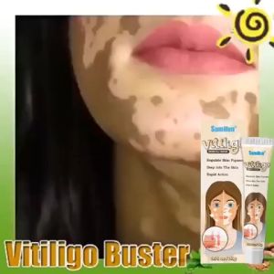 Vitiligo Removal Cream White Spot Care Cream Skincare cream 20g vitiligo skin treatment Sweat spot Reduce white spots Skin care 白癜风白斑治疗霜