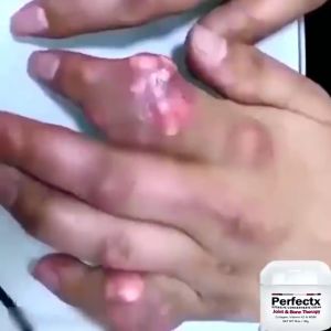 Perfectx Joint Bone Therapy Collagen Cream Deformation Correct Cream Intensive Concentrate for Joint and Muscle Perfectx Review - Lazada