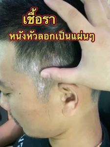 เเชมพูพญายอ 2ขวด 450.-จบปัญหาหนังศรีษะ การหยุดร่วงของเส้นผม ขจัดรังแค ลดอาการคัน