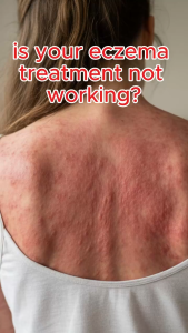 Miracle manuka for sensitive skin prone to eczema