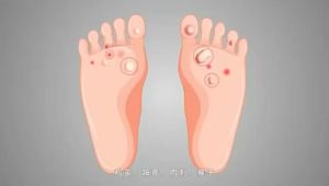 Wart Remover Cream Traditional Natural Mole Ubat buang kutil Skin Care Skin Tag & Wart Removal Mole Remover All Skin Types Warts 10ml