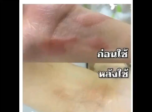 ครีมลดรอยแตกลาย ทา7วันหาย ครีมทาท้องลายแก้ท้องลาย ลดรอยแตกลาย ขาแตกลาย สะโพกลาย ผิวลาย รอยแตกลาย