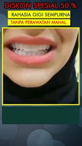 Snap On Smile 100% Original Authentic / Gigi Palsu Snapon Smile 1 Set Veneer Gigi palsu