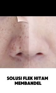 HYALURA Serum Glowing - Memudarkan Flek Hitam dan Bekas Jerawat