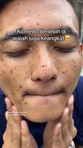 [VIRAL SALE] SALSA Hans Jebb Peeling Gel - Perontok Daki dan Ketiak Hitam BPOM