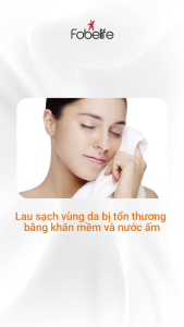 Kem Bôi FobeGel Nano Bạc Keo Ong Xanh – Làm Dịu Da Tay Chân Miệng Zona Thủy Đậu Kiến Ba Khoang