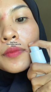 The Originote Acne B5 Serum 20ml Serum Anti Acne Anti Inflamasi Untuk Merawat Dan Mencegah Pertumbuhan Jerawat