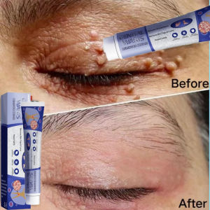 Painless Warts removal cream 20g skin tags remover warts remover original watson mole remover ubat hilangkan ketuat 点痣药膏