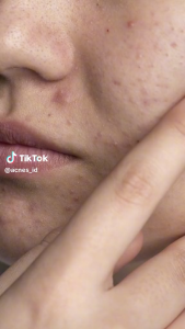 Review Produk: Acnes Spot Care 12g & Obat Jerawat Acnes