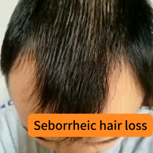 RAVINIA Hair loss shampoo  Ginger shampoo 200ml Anti hair loss shampoo Effectively prevent hair loss 生發洗发水