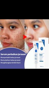 Acne removing gel essence  Closed mouth acne  Acne essence  20g  Shrink pores  Improve blackheads  Delicate skin  Closed mouth acne mark