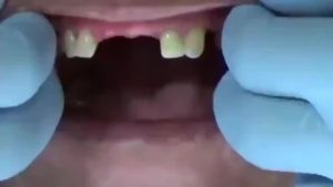 2Pcs/Set Silicone Teeth Whitening Teeth Cover Teeth Braces Simulation Denture Upper Teeth Lower Teeth Set with Box Perfect Smile