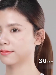 Kem/gel xóa sẹo nhẹ nhàng ức chế tăng sinh sẹo dưỡng ẩm và làm mềm thúc đẩy phục hồi da chống viêm và làm mờ sẹo và vết rạn da 40g