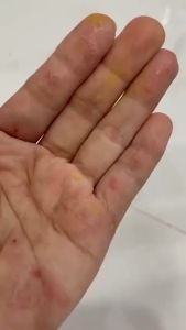 Kem bôi viêm da Nhật Bản giảm tình trạng lác hắc lào lang ben vảy nến á sừng nấm tay chân mề đay