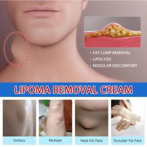 Removal of lipoma cream of skin swelling ointment lipoma removal ointment 脂肪瘤膏30g ,removal of multiple single lipoma subcutaneous lipoma quick pain relief treatment of tumor skin swelling ointment raised skin lump cream body care