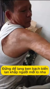 Kem làm sạch bạch biến chăm sóc da giảm đốm nâu da