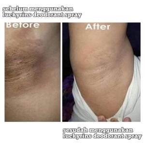 PENGHILANG NODA HITAM PADA KETIAK PALING AMPUH