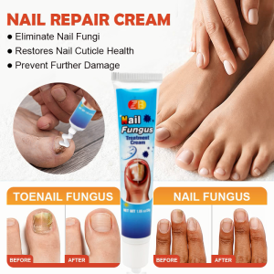 ZB Nail Fungus Treatment Cream-Giải Pháp Chống Nấm Hiệu quả Cho Móng Chân & Móng tay 20g