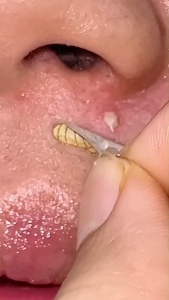 SimplyHeal Day & Night Premium Hydrocolloid Acne Patch X Artist Collab