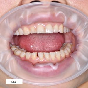 5 CÁI Dụng Cụ Phục Hồi Chỉnh Nha Linh Hoạt Không Chứa Latex Hình Chữ O 3D Dành Cho Nha Khoa - Kích Thước Lớn/vừa/nhỏ