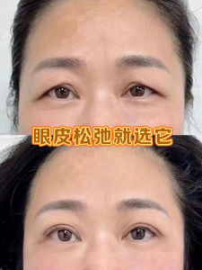 Eyes Lifting Invisible Double Eyelid Tape for Preventing Eyelid Sagging Men And Women Suitable Any Skin Type Waterproof
