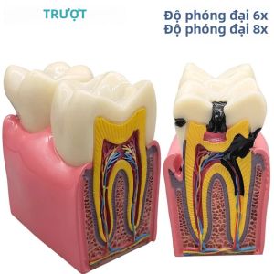 8x Nha Khoa Caries Mẫu Nhựa Răng Trình Diễn Giảng Dạy Cho Nha Sĩ Răng Miệng Phòng Thí Nghiệm Nha Khoa Mẫu