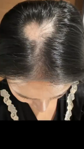 Lăn Mọc Tóc Chính Hãng Mocha Hairborn giúp giảm rụng tóc 60ml