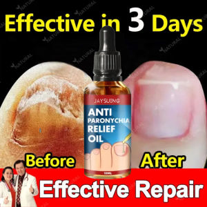 Jaysuing Dầu Giảm Đau Viêm Móng Chân Mọc Ngược Chữa Đau Dung Dịch Sửa Chữa Giảm Đau Móng Chân Mọc Ngược Chất Khử Trùng Chống Nấm Làm Mềm Chăm Sóc Chữa Bệnh Viêm Móng Giảm Đau Dầu Phục Hồi 10Ml - Lazada