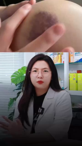 Kem Bôi Giảm Bầm Tím– Làm Tan Máu Bầm Giảm Thâm Dưỡng Da Sau Té Ngã Va Chạm Sau Thẩm Mỹ