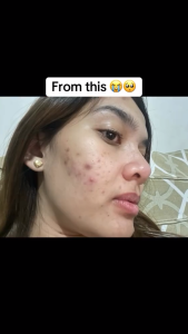 Buy 2 Beautederm Premium Set Promo for 6500php only!