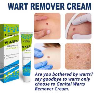 Wart Remover Ointment krim penanggal ketual kutil skin tag tahi lalat biji kolestrol