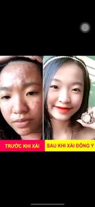 Tặng mặt nạ dưỡng da Kem Mụn Đông Y Hoa Đào Sạch Mụn Trắng Da Mờ Nám Chấm Mụn